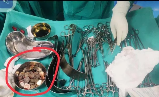 Doctors Remove Coins From Old Man Stomach In Karnataka - Sakshi