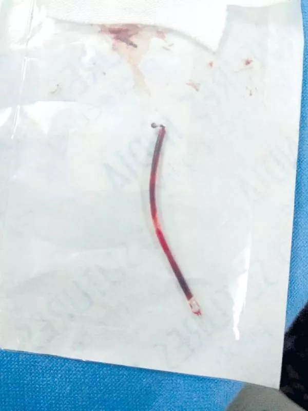 A broken needle in the blood vessel - Sakshi