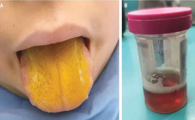 A Boy With Bright Yellow Tongue And EpsteinBarr Virus Diagnosed In Canada - Sakshi