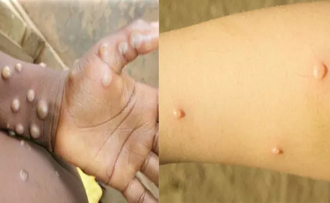 Differences Between Monkeypox Chickenpox Check Here - Sakshi