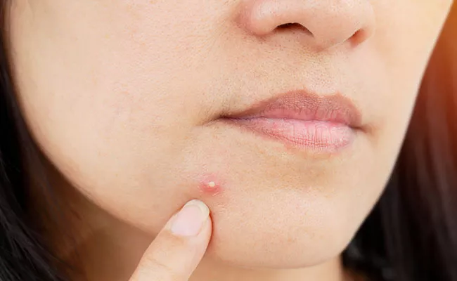 Beauty Tips In Telugu: Mint Amazing Benefits For Acne Free Skin - Sakshi