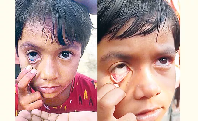 Rice Nails From Girls Eyes Parents Concerned Doctors Clarity - Sakshi