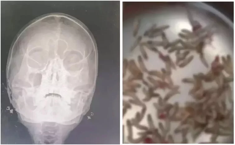 Woman With Stuffed Nose Finds 100s Of Maggots Living Inside Her Nostrils