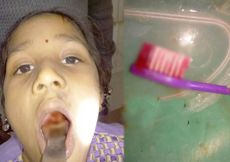 brush stuck in six years child throat - Sakshi