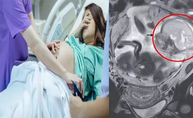 France Woman Shock Stomach Pain Turns To Be Baby Growing In Bowel - Sakshi