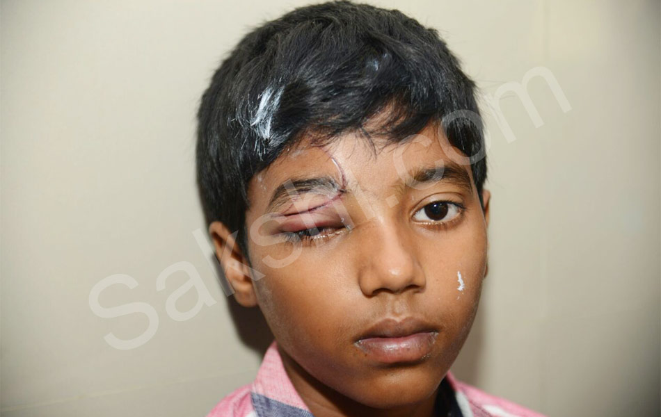 Diwali Eye Accidents in Hyderabad - Sakshi5