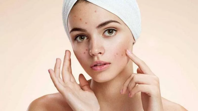 Reasons And Prevention For Acne - Sakshi