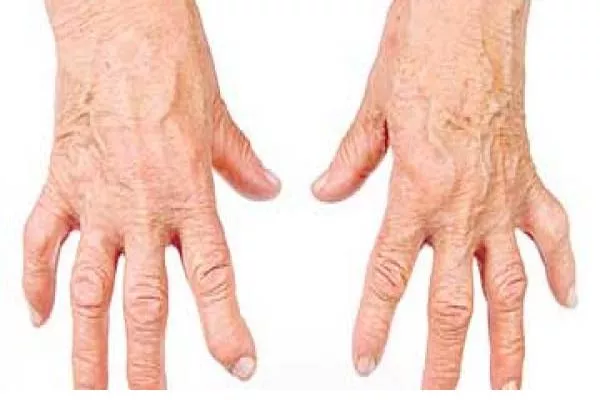 Rheumatoid Arthritis In Janagama  - Sakshi