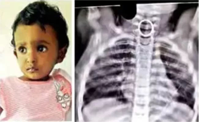 2 Years Old Girl Swallows Ring In Tamil Nadu - Sakshi