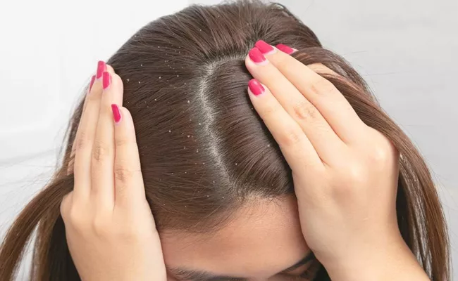 Dandruff Irrigation Try These 2 Simple Tips In Telugu To Healty Hair - Sakshi