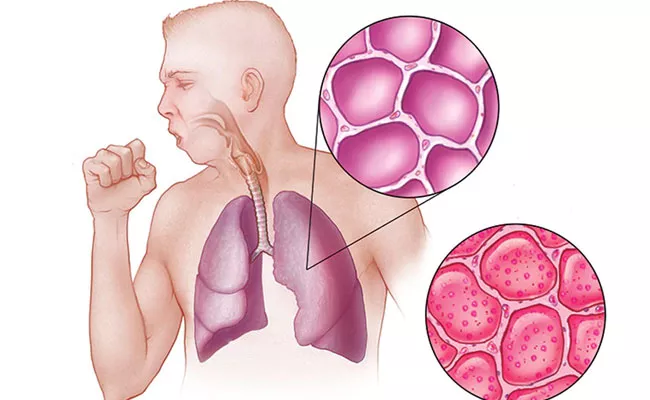 Pneumonia Causes, Symptoms, Diagnosis And Treatment - Sakshi