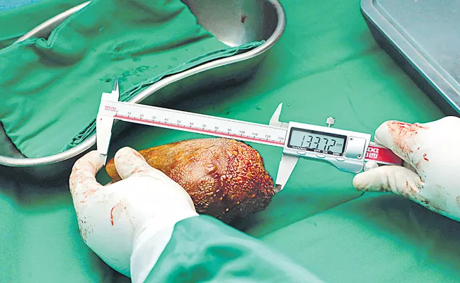 Sri Lanka doctors remove world largest kidney stone - Sakshi