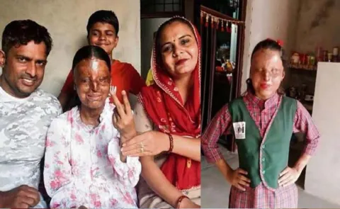 Dreaming of IAS 17 Year Old kafi Acid Attack Survivor Tops 14
