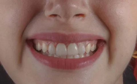 German Man Says Indians Have Good Dental Hygiene Goes Viral