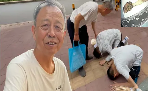 52 Years China Man Lived Toothbrush in Intestine After Swallowing At Age 12