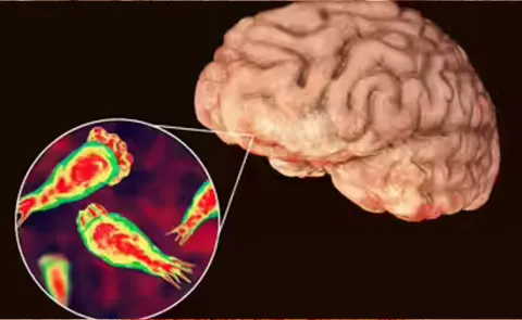 Brain Eating Amoeba Kills 19 in Kerala5