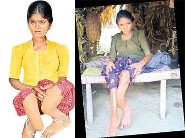 ఫ్లోరైడ్కు విరుగుడేదీ..? - Sakshi