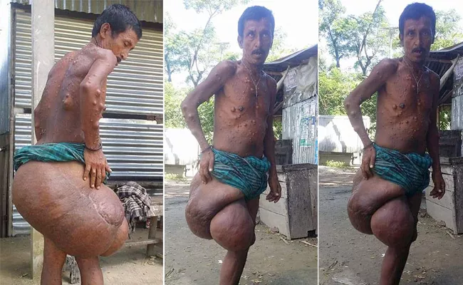 53-year-old recluse is plagued by a 6-stone tumour on his thigh that makes children 'scared' of him