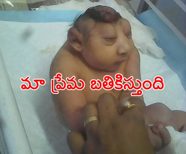 Doctors warn there is 'nothing' they can do to save the life of baby born with encephalocele