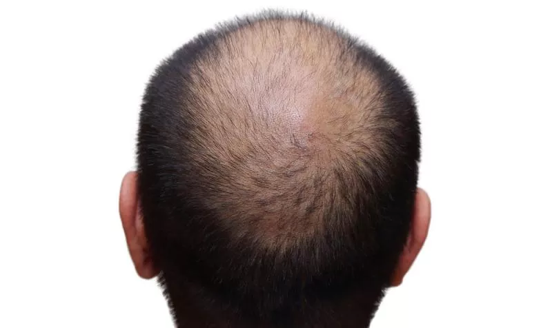 Baldness, premature greying may up heart disease risk in men  - Sakshi