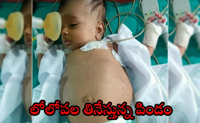 Surgeons operating on baby to remove 'tumour' from stomach discover growth is actually its twin - Sakshi