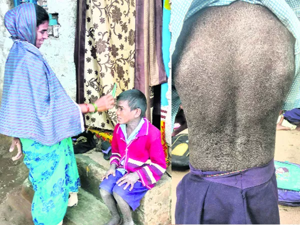 boy suffered from iktiyozis vulgaris - Sakshi