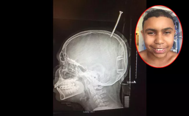 Boys skull pierced with screw in treehouse-building accident - Sakshi