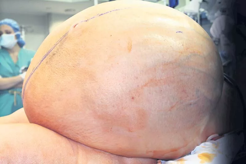 Doctors in US remove tumour weighing 60 kg from woman's abdomen - Sakshi