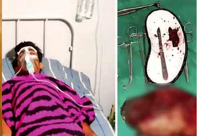 Surgeons recover 2kg chunk from teen's stomach - Sakshi