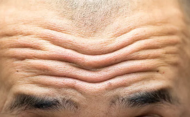 Forehead Wrinkles Sign For Cardiovascular Disease Says Studies - Sakshi