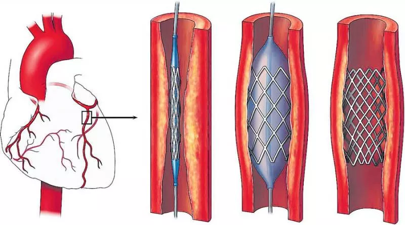 Made in India coronary stents as good as foreign ones - Sakshi