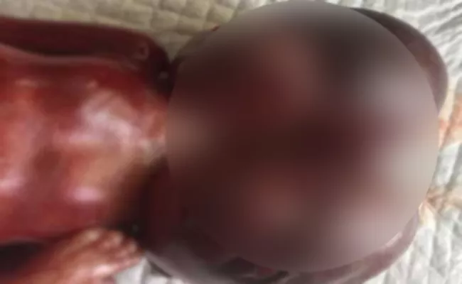 Two Headed Baby Delivered In Hyderabad - Sakshi