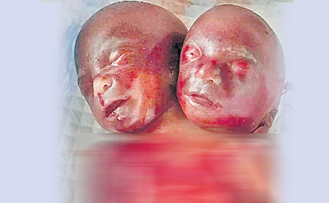 Baby with two heads - Sakshi