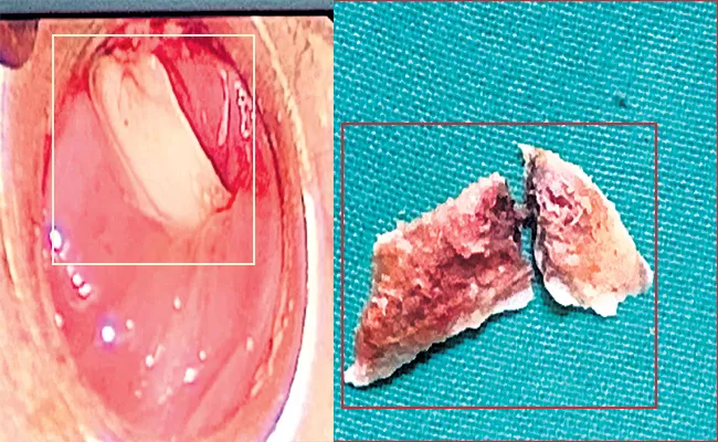 Care Hospital Doctors Surgery With Laser in Throat - Sakshi