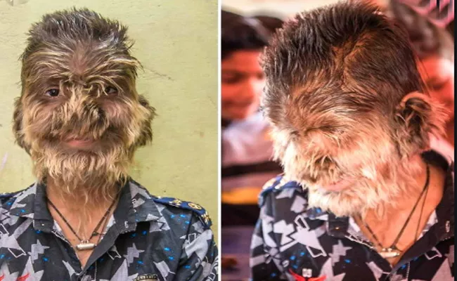 What are the Symptoms of Werewolf Syndrome? - Sakshi