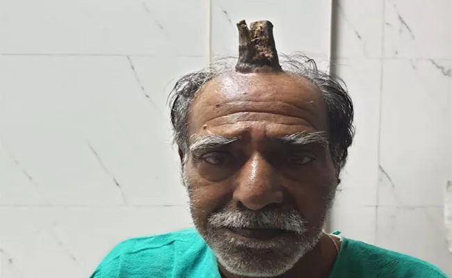 MP Old Man Suffers From Devil Horn After Injury Removed - Sakshi