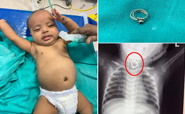 Five Year Old Boy swallows Ring - Sakshi