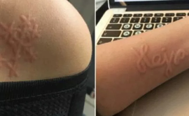 Denmark Teen With Rare Skin Allergy Turns Herself Into Human Etch A Sketch - Sakshi