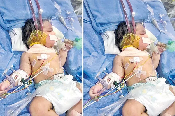 Days Baby Saved KIMS Doctors with ECMO Treatment - Sakshi