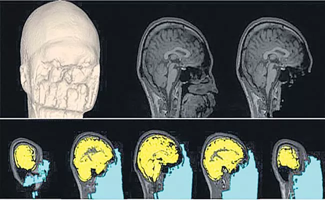 Changes In Brain Function With Decoded Neuro Feedback Technology - Sakshi