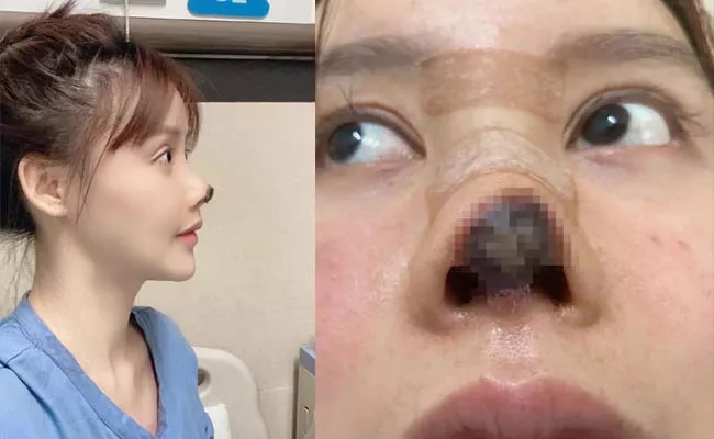 Chinese Star Shares Shocking Pics Of Nose Surgery Goes Misfire - Sakshi