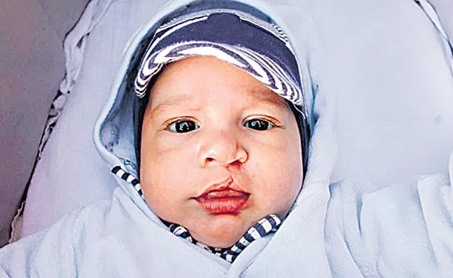 Cleft Palate Disease Special Story - Sakshi