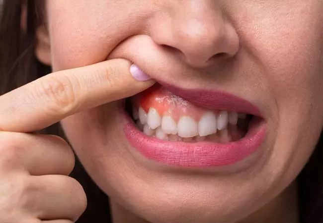 COVID-19 Patients With Gum Disease More Likely To Develop Complications That Could Lead To Death - Sakshi