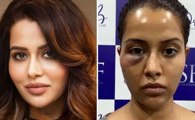 Tamil Actress Raiza Wilson Undergo Dermatological Procedure, It Goes Wrong - Sakshi