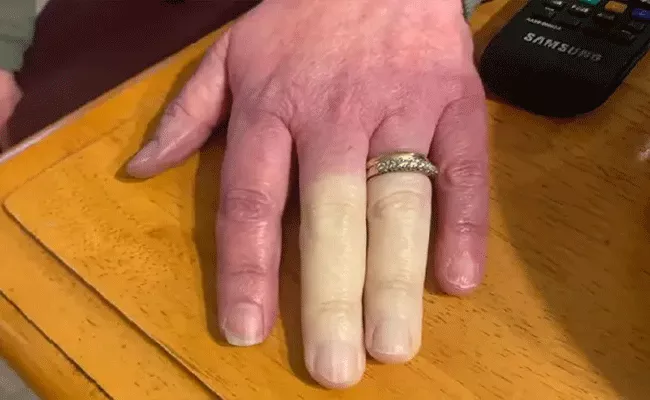 Shocking: Woman Hand Fingers Turns Complete Patch White Colour Goes Viral - Sakshi