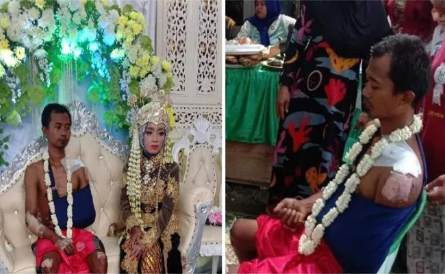 Indonesia Injured Groom Wears Just A Pair of Shorts on His Wedding Photos Go Viral - Sakshi