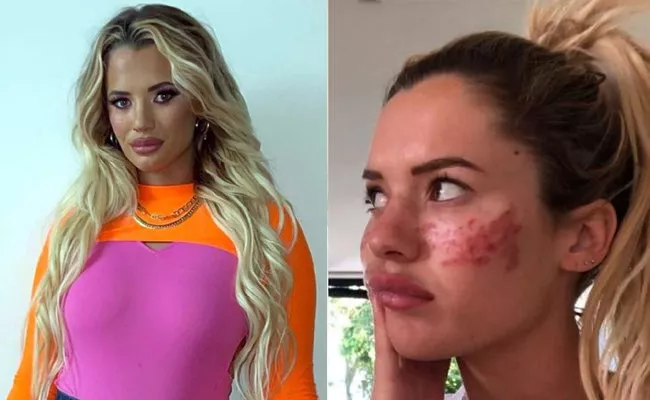 Big Brother Contestant Tilly Whitfield Eyes Damaged After Using TikTok Beauty Tip - Sakshi