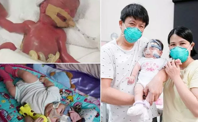 Hong Kong Guinness Record Tiny Apple Baby Survived After Long Treatment - Sakshi