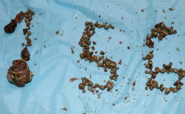 Record 156 Kidney Stones Removed From Single Patient In Hyderabad - Sakshi