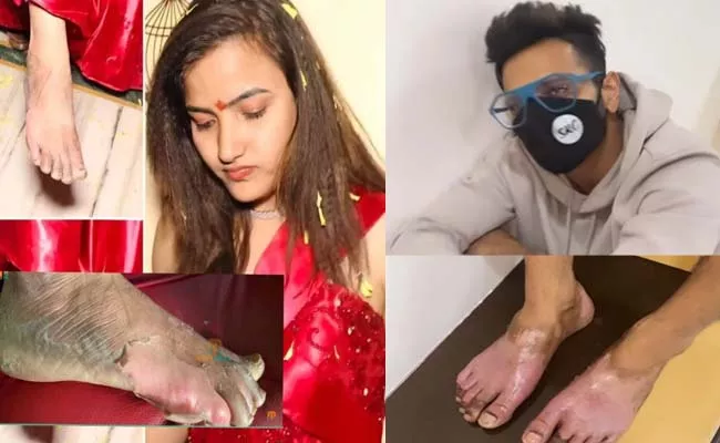 Bigg Boss 5 Telugu: Shocking Pictures of BB5 Siri and Sreeram Chandra Feet After Ice Task - Sakshi